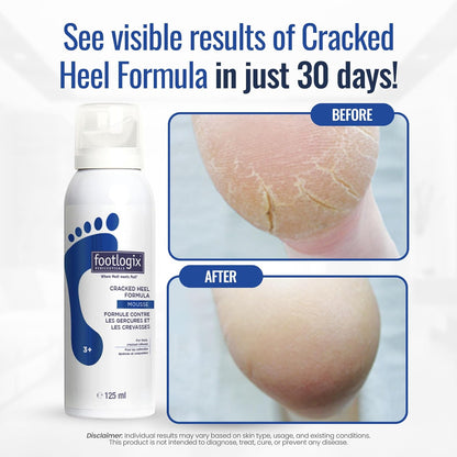 Footlogix Cracked Heel Formula 125 mL (4.23 fl oz)